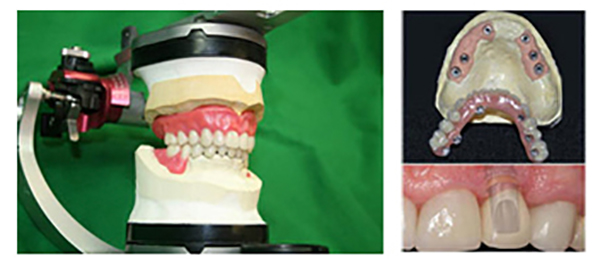 Laboratorio Dental José Montes implantes dentales